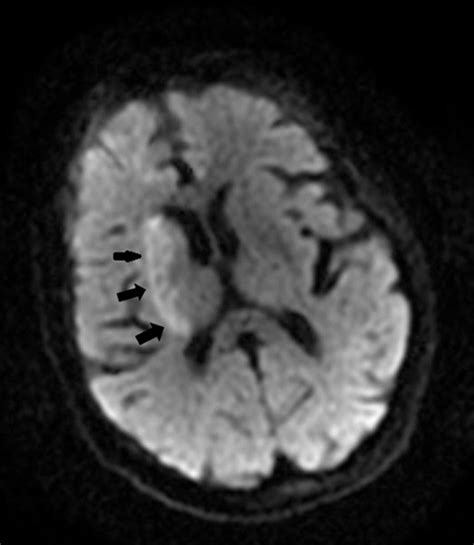 A case of large right MCA stroke with hyperdense MCA sign in CT imaging ...