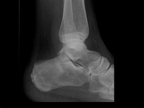 Calcaneus Fracture