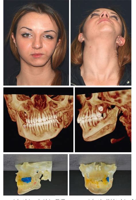 [PDF] Reconstruction of the Adult Hemifacial Microsomia Patient with ...