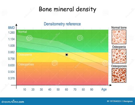 Densitometry Reference. Osteopenia and Osteoporosis. Aging Process ...