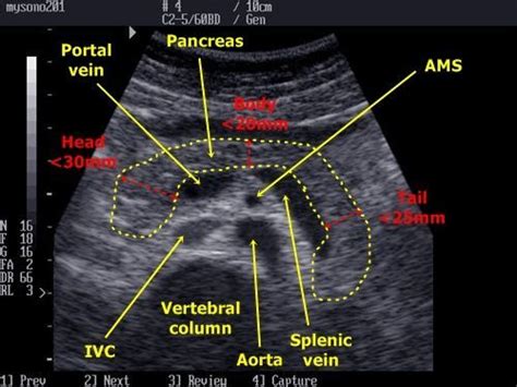 Long Pancreas w/vascularity labeled | Sonography, Ultrasound, Medical ...