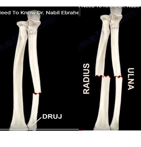 Radius and Ulna shaft fractures — OrthopaedicPrinciples.com