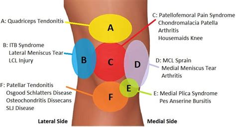 Knee pain: Our knee pain diagnosis chart helps you to work out what is ...