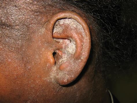 Crusted (exaggerated, Norwegian) scabies - Dermatology Advisor