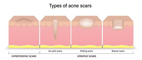 Atrophic Scars: Over 45 Royalty-Free Licensable Stock Vectors & Vector ...