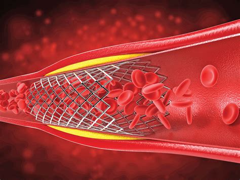 Complications after receiving a stent - Harvard Health