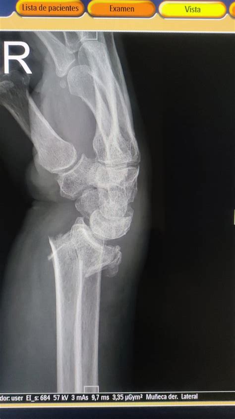 Colles fracture : r/XRayPorn