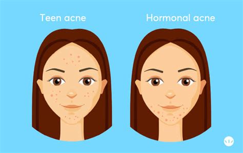 Do you have hormonal acne? Find out what to avoid! - HealthFacts NG