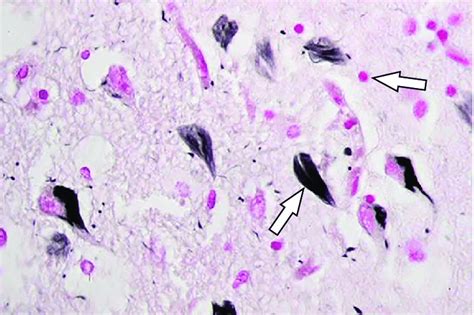 Amyloid plaques (pink) and neurofibrillary tangles (black) in ...