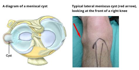 Meniscal Cyst – Agile Ortho