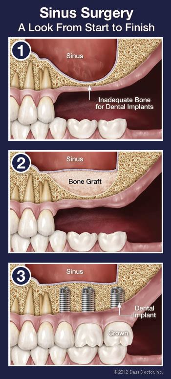 Sinus Surgery - Dentist Dewitt, MI - Dental Education Library