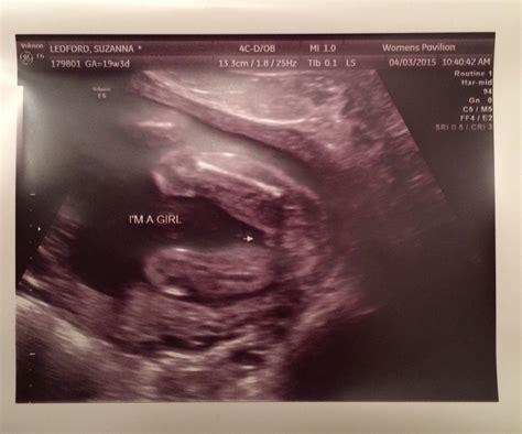 It's a girl! 19 week ultrasound | 19 week ultrasound, Girl, Ultrasound