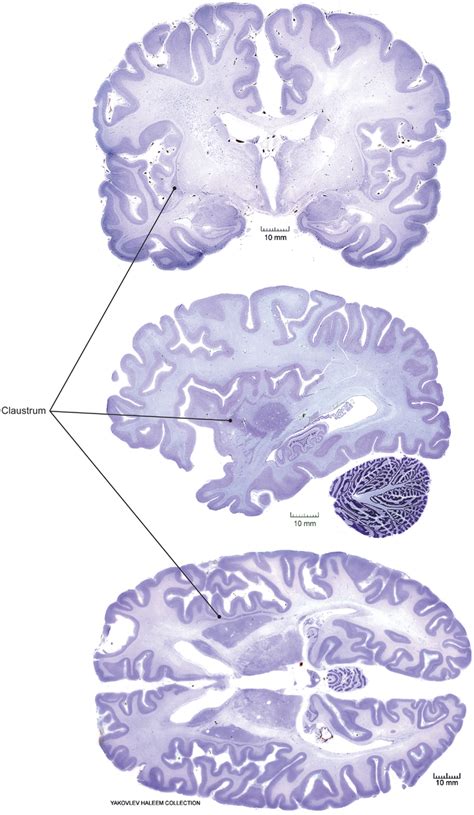 Claustrum location in human brain. Coronal (top), sagittal (middle ...