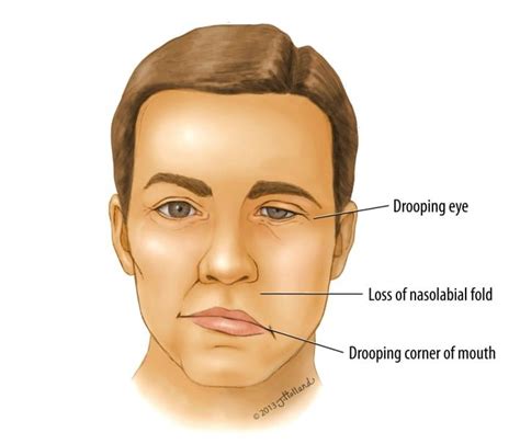 Bell’s palsy - Symptoms, causes and other risk factors