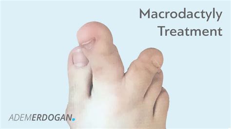 Macrodactyly / Local Gigantism of the Toes | Foot Surgeon Adem Erdogan