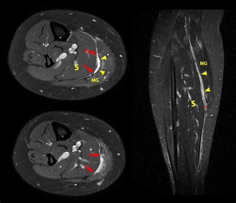 Not the Plantaris – Keys to Better Diagnosis of Calf Strain Injuries ...