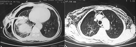 (A) Contrast enhanced CT thorax showing chest tube lying in the right ...