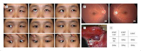 Anterior and Nasal Transposition of the Inferior Oblique Muscle for ...