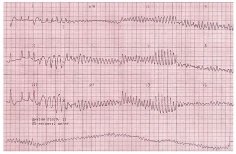 Ventricular Fibrillation