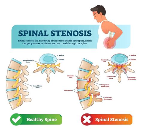 Herniated Disc vs. Spinal Stenosis: How Do They Differ?