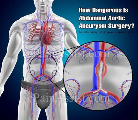 How Dangerous Is Abdominal Aortic Aneurysm Surgery? | Abdominal aortic ...