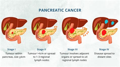 Colon Cancer and Pancreatic Cancer treatment in India - Dr Pawan Rawal