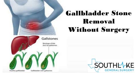 Gallbladder Stone treatment Archives - Southlake General Surgery