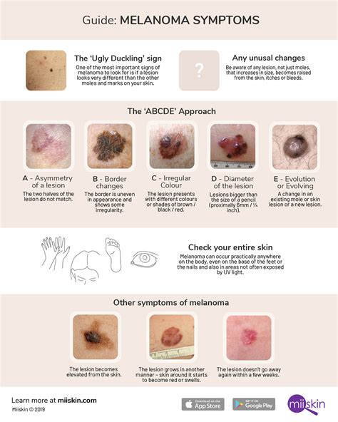 Malignant Melanoma Symptoms And Signs: Understanding the Warning ...