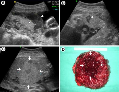 The clinical significance of large placental lakes - European Journal ...