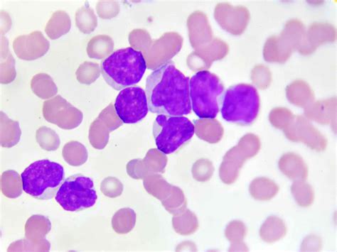 How Acute Myeloid Leukemia Is Diagnosed