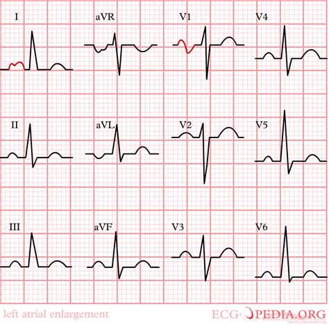 Left atrial enlargement electrocardiogram - wikidoc