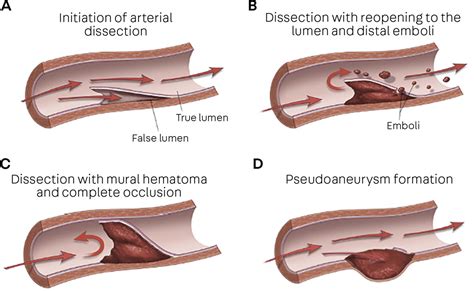 Cervical Artery Dissection : CONTINUUM: Lifelong Learning in Neurology