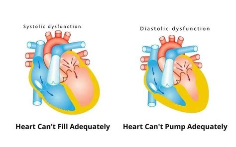 Systolic Heart Failure vs Diastolic Heart Failure: Symptoms, Diagnosis ...