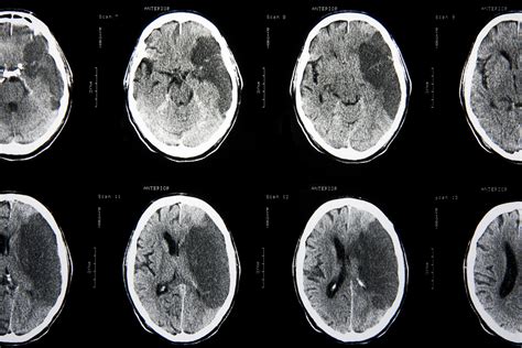 Diagnosis Of Ischemic Stroke - Net Health Book