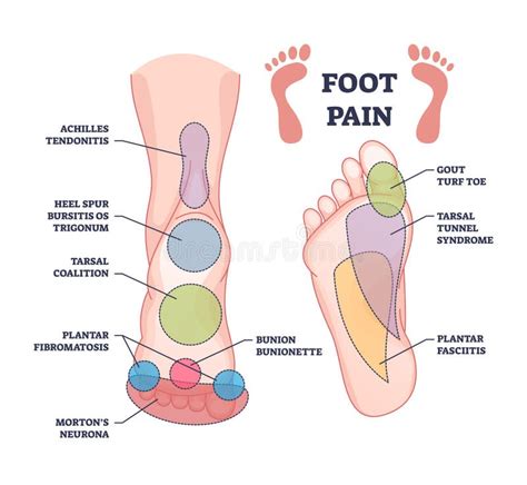 Foot Pain Causes from Zones Diagnosis and Painful Spots Areas Outline ...