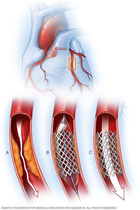 Coronary artery stent - Mayo Clinic