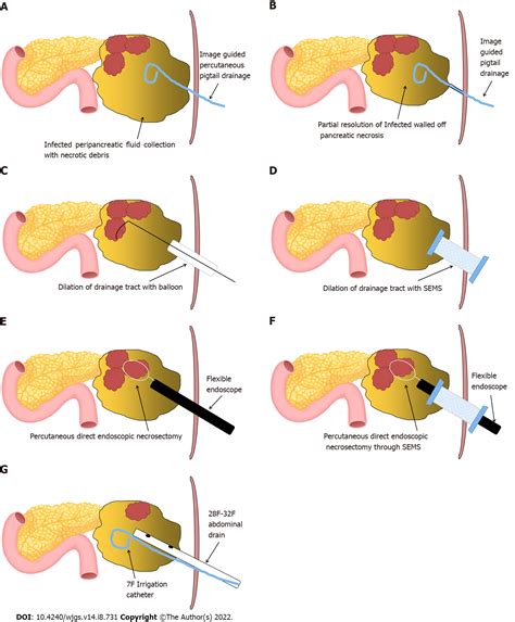 Percutaneous direct endoscopic pancreatic necrosectomy