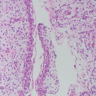 Dentigerous cyst, hematoxylin and eosin, 200x. Histology revealed an ...