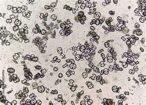 Microscopic image showing calcium oxalate monohydrate, uric acid ...