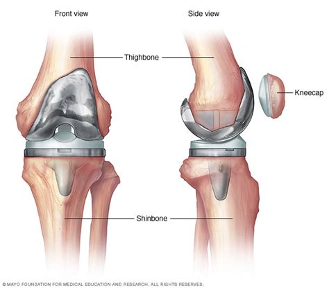 Knee replacement surgery - Mayo Clinic