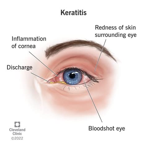 Keratitis: Types, Symptoms & Treatment