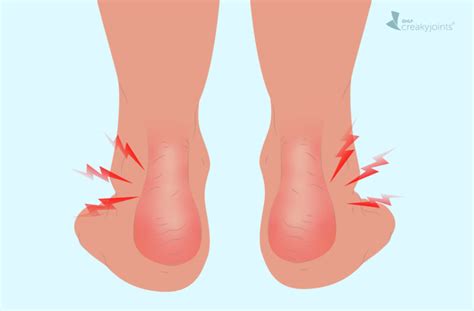 Psoriatic Arthritis in the Ankle: Symptoms, Causes, Treatments