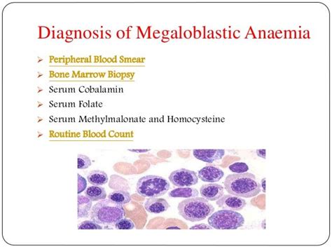 Megaloblastic Anaemia: Symptoms, causes, diagnosis, treatment and pre…