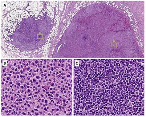 Conventional histology of cervical lymph node biopsy specimen. A ...