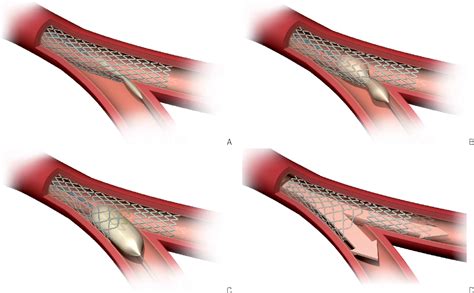 Stentys coronary bifurcation stent. | Semantic Scholar