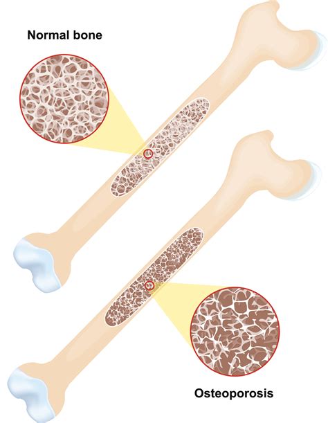 Osteoporosis Symptoms, Diagnosis and Treatment | Saint John’s Cancer ...