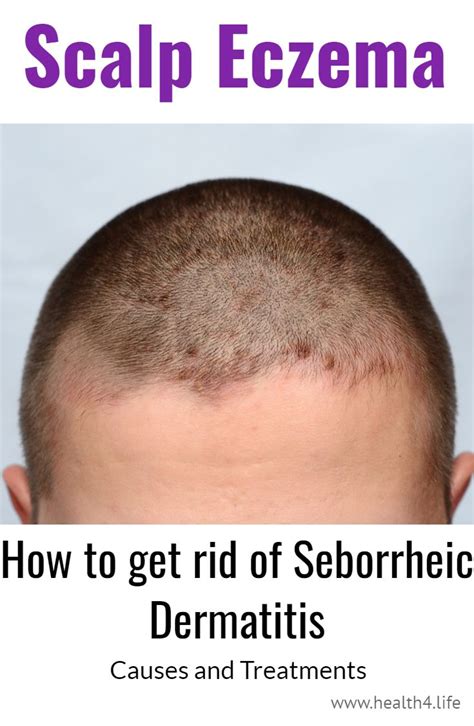 How to get rid of eczema on your head or scalp. Seborrheic Dermatitis ...