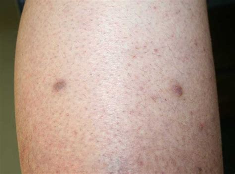 Prurigo Nodularis (Prurigo Nodularis of Hyde) - Dermatology Advisor