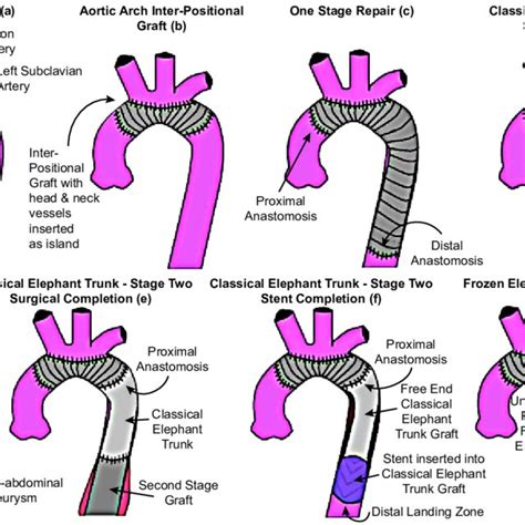 (PDF) Frozen elephant trunk as an effective alternative to open and ...