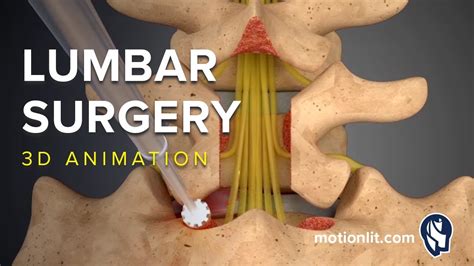 Lumbar Surgery - Laminectomy - 3D Medical Animation - YouTube